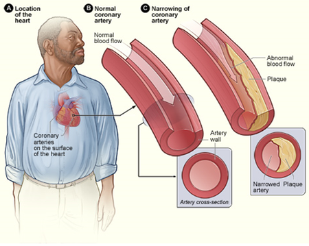 Cholesterol Plaque - Key Stage Wiki